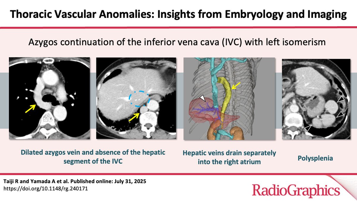 RadioGraphics's tweet image. Confused about vascular anomalies at chest imaging? Check out this article to review the embryology and imaging findings regarding these anomalies! bit.ly/4lMeYGU