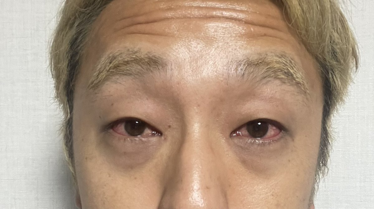 s0930s1's tweet photo. お疲れ様です。

只今結膜炎によりrental satoshi休業中です。。
初手右目からの両目なりました。。

決死の覚悟で現場仕事に行きましたが周りの諸先輩方からは移るから現場に来るなと言われ帰り際にご馳走してくれたジュースの小銭は地面に。。。
結膜炎に人権はありませんでした。

早く治します。 https://t.co/o124mcqr2A