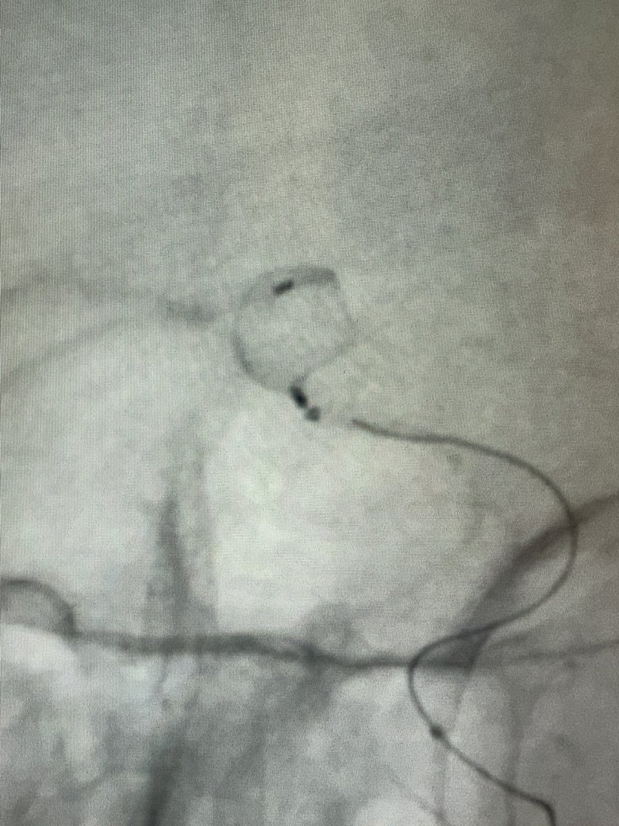 Adam Kobayashi (@adamkobayashimd) on Twitter photo Today <a href="/WMCM_UKSW/">Faculty of Medicine, Cardinal Wyszynski University</a> we have entered a new era of endovascular brain aneurysm treatment 🧠.
Our first case of Artisse intrasaccular device implantation for ACom aneurysm with complex anatomy
<a href="/FilipMSzymanski/">Prof. Filip M. Szymanski</a> <a href="/PTChCpl/">PTChC 🩺 Polish Society of Civilization Diseases</a> <a href="/esmintsociety/">ESMINT Society</a> <a href="/svinsociety/">SVIN</a> <a href="/ESOstroke/">European Stroke Org</a> <a href="/neurologiczne/">Polskie Towarzystwo Neurologiczne</a> Today <a href="/WMCM_UKSW/">Faculty of Medicine, Cardinal Wyszynski University</a> we have entered a new era of endovascular brain aneurysm treatment 🧠.
Our first case of Artisse intrasaccular device implantation for ACom aneurysm with complex anatomy
<a href="/FilipMSzymanski/">Prof. Filip M. Szymanski</a> <a href="/PTChCpl/">PTChC 🩺 Polish Society of Civilization Diseases</a> <a href="/esmintsociety/">ESMINT Society</a> <a href="/svinsociety/">SVIN</a> <a href="/ESOstroke/">European Stroke Org</a> <a href="/neurologiczne/">Polskie Towarzystwo Neurologiczne</a>