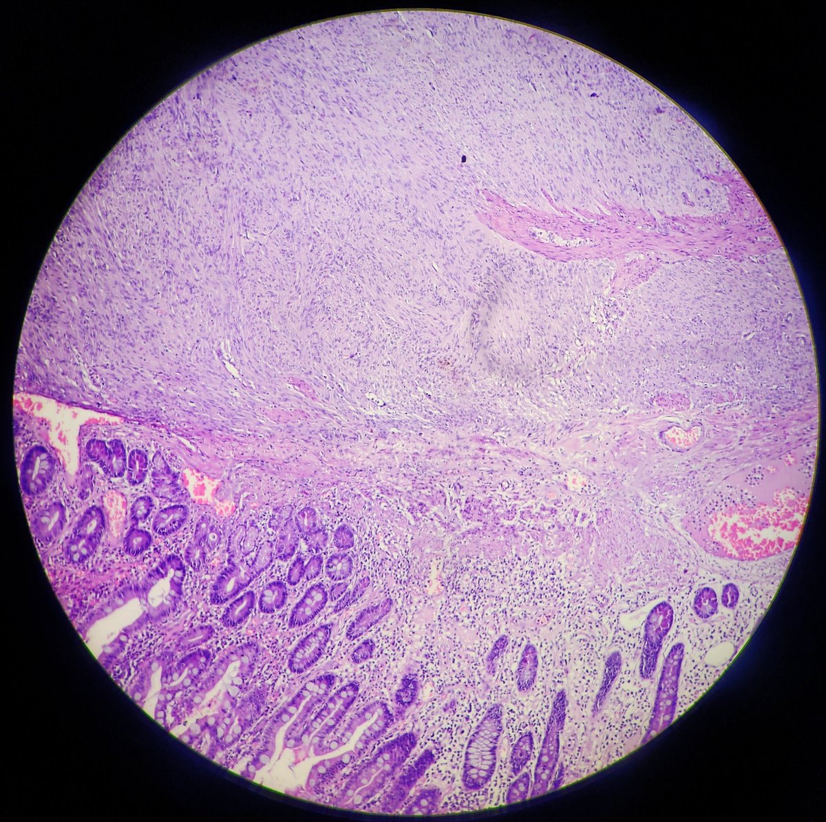 SyedSal55391459's tweet image. #histopathology
#GIT
#GIST
#pathX
#pathTwitter
#cellphonephotograph
Dx: Gastrointestinal stromal tumor (GIST).
