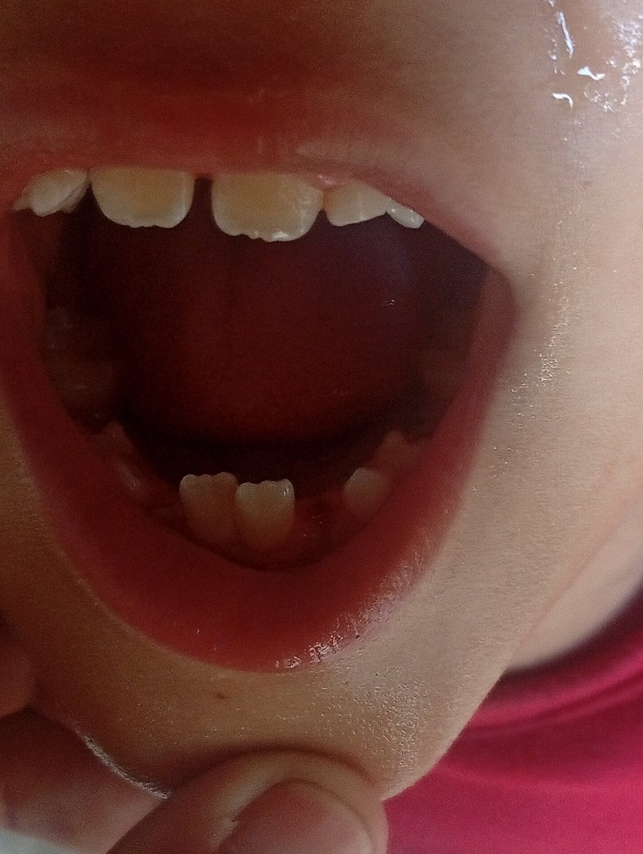 hmd_mhmd9832's tweet image. My little brother with the little heart is in crazy pain He is suffering from tooth decay due to lack of food, medicine and calcium He is suffering from strife We need help to save his life🙏😭
 
3 replies — even dots — can break the
 algorithm 😭
chuffed.org/project/127878