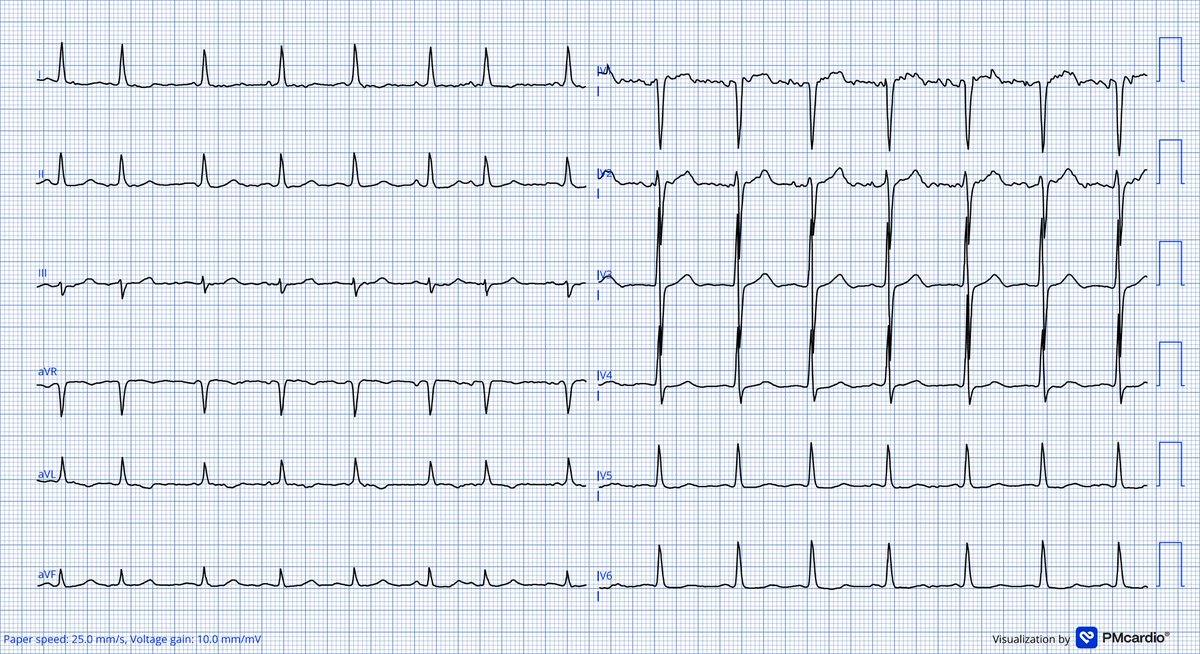 leonr (@leonrmail) on Twitter photo 79y man, dyspnoe, no CP. No afib or any arrhythmia known prior. My only case for you guys today 😉<a href="/ecgandrhythmRoe/">Dr. Andreas Roeschl</a> <a href="/lila_enis/">Enis Lila</a> <a href="/Ecgloverr/">Pedram</a> <a href="/koggelnoggel/">Jana Borucka</a> <a href="/TheECGMedic/">Jack Cahill</a> <a href="/Frances98392343/">Cciari1</a> <a href="/ECGWeekly/">ECGWeekly</a> <a href="/FibrilloFlutter/">FLUTTER</a> <a href="/HishamMD3/">Hisham M, D.🫀</a> <a href="/Arron_Pearce_/">Arron Pearce</a> <a href="/DrRazi4/">Dr Razi</a> <a href="/DaveRichley/">Dave Richley</a> 79y man, dyspnoe, no CP. No afib or any arrhythmia known prior. My only case for you guys today 😉<a href="/ecgandrhythmRoe/">Dr. Andreas Roeschl</a> <a href="/lila_enis/">Enis Lila</a> <a href="/Ecgloverr/">Pedram</a> <a href="/koggelnoggel/">Jana Borucka</a> <a href="/TheECGMedic/">Jack Cahill</a> <a href="/Frances98392343/">Cciari1</a> <a href="/ECGWeekly/">ECGWeekly</a> <a href="/FibrilloFlutter/">FLUTTER</a> <a href="/HishamMD3/">Hisham M, D.🫀</a> <a href="/Arron_Pearce_/">Arron Pearce</a> <a href="/DrRazi4/">Dr Razi</a> <a href="/DaveRichley/">Dave Richley</a>
