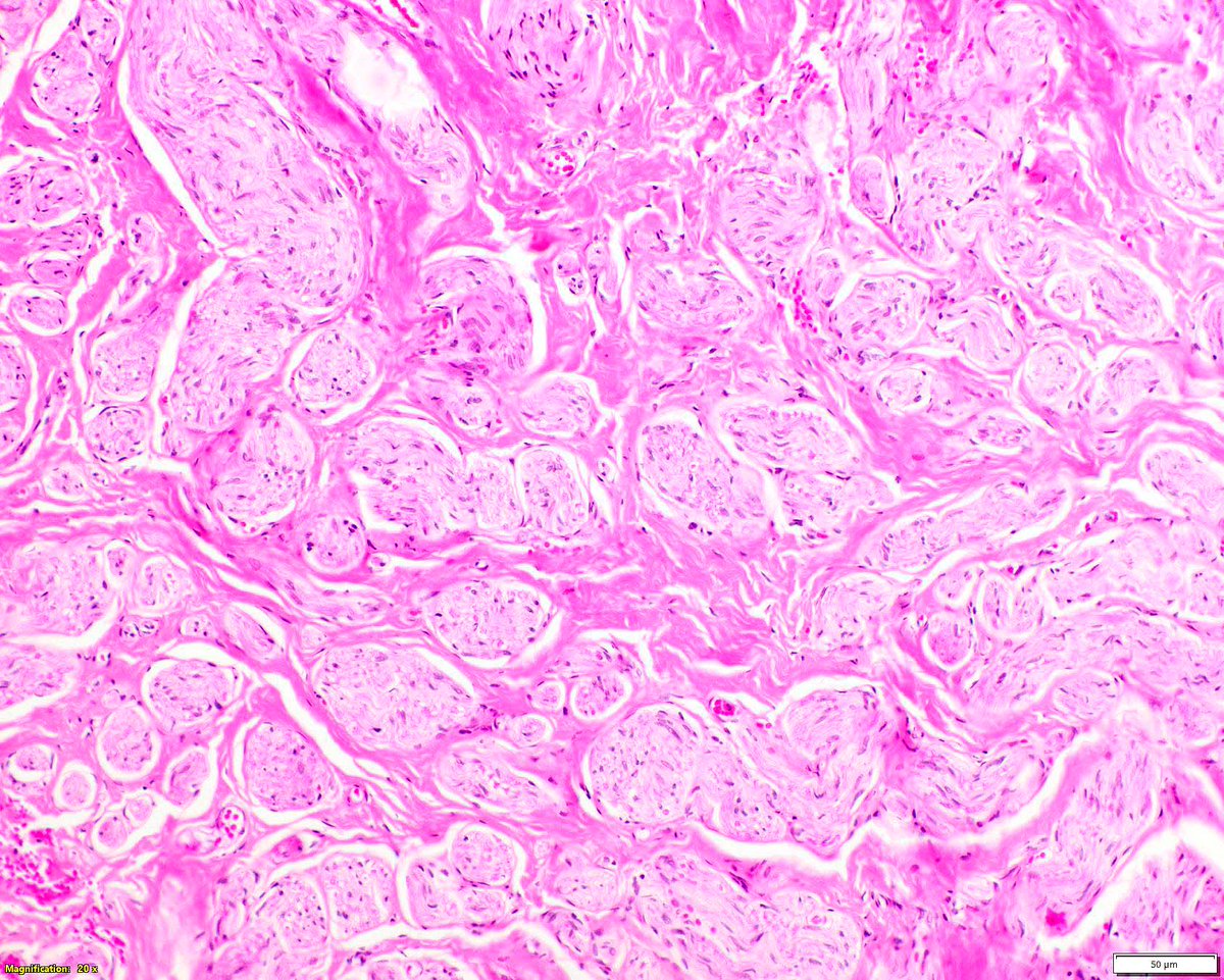 Modern Pathology (@modernpathology) on Twitter photo In traumatic neuromas, the individual nerve packets are each cuffed by perineurium. A vintage Mod Pathol study demonstrated this.
Hirose T, Tani T, Shimada T, Ishizawa K, Shimada S, Sano T. Immunohistochemical demonstration of EMA/Glut1-positive perineurial cells and In traumatic neuromas, the individual nerve packets are each cuffed by perineurium. A vintage Mod Pathol study demonstrated this.
Hirose T, Tani T, Shimada T, Ishizawa K, Shimada S, Sano T. Immunohistochemical demonstration of EMA/Glut1-positive perineurial cells and