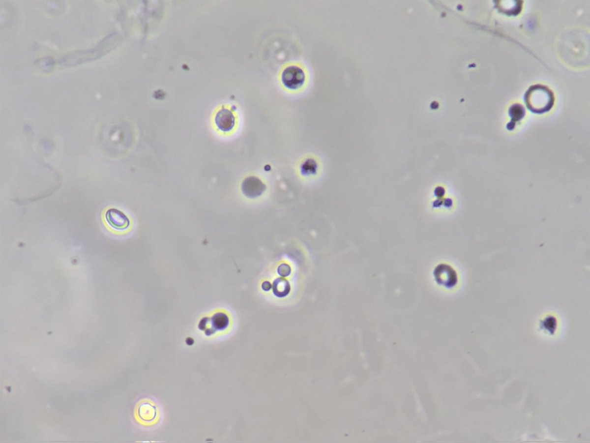 neph_ag's tweet photo. #UrineSediment #UrineMicroscopy https://t.co/Ic6XE8ijXE