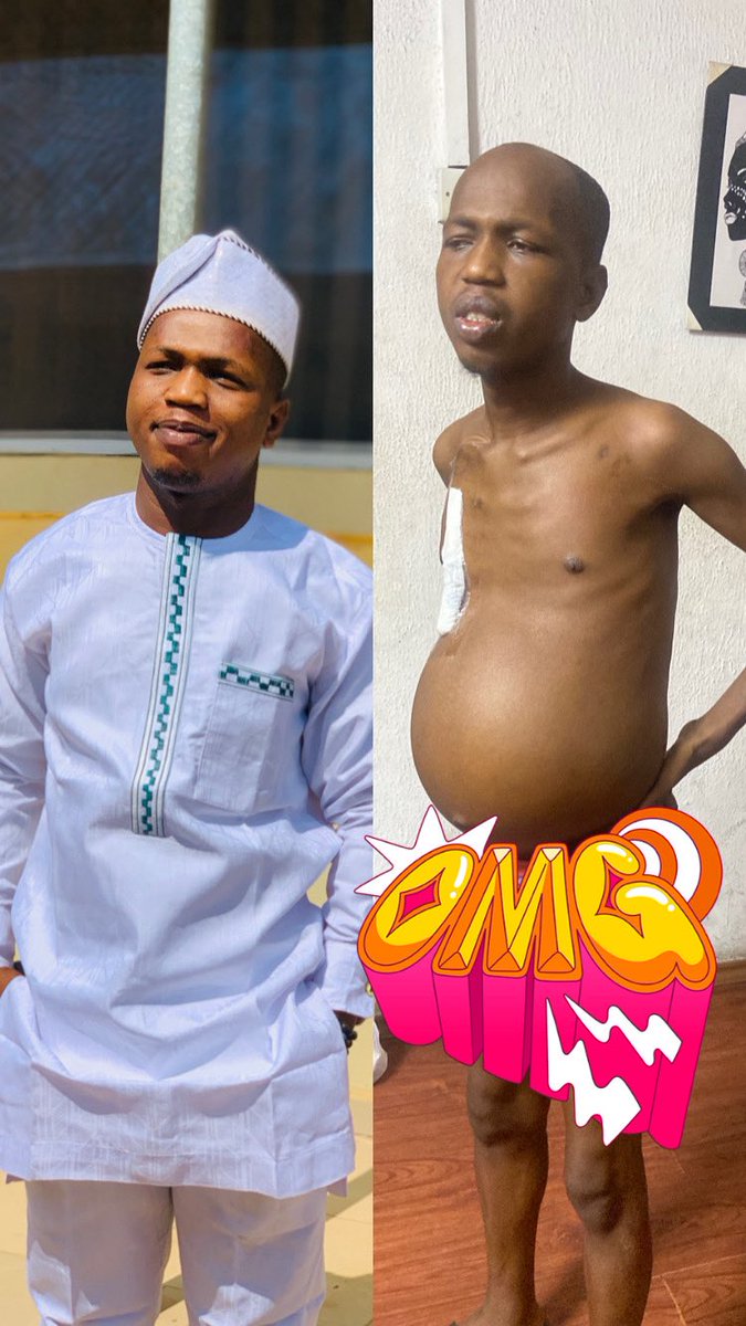 Help AbdulRazaq live a normal life! He's battling chronic kidney &amp; liver disease &amp; needs #18.02m for surgery. 

Donate via 
GTB 0460135107 or 
First Bank 3218574325. 
GoFundMe: (gofund.me/09346843). 

Let's support him! 🙏🏽💕 #HelpAbdulRazaq