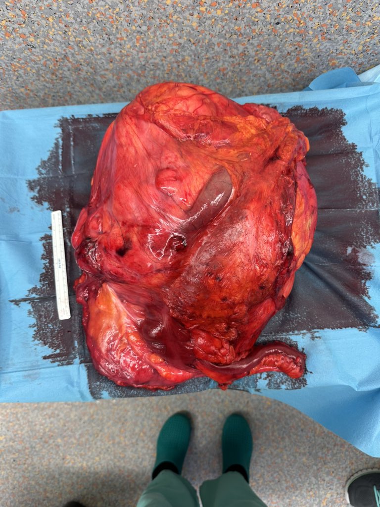 👉🏻Avanzamos en el tratamiento de los #Sarcomas #retroperitoneales con el primer caso de #RadioterapiaIntraoperatoria en #Asturias 
<a href="/SarcomasAEC/">AEC Sarcomas</a> <a href="/EstrellaTurien1/">Estrella Turienzo</a> <a href="/HUCA_Asturias/">@HUCA</a> <a href="/mmorenogijon/">María Moreno Gijón</a>