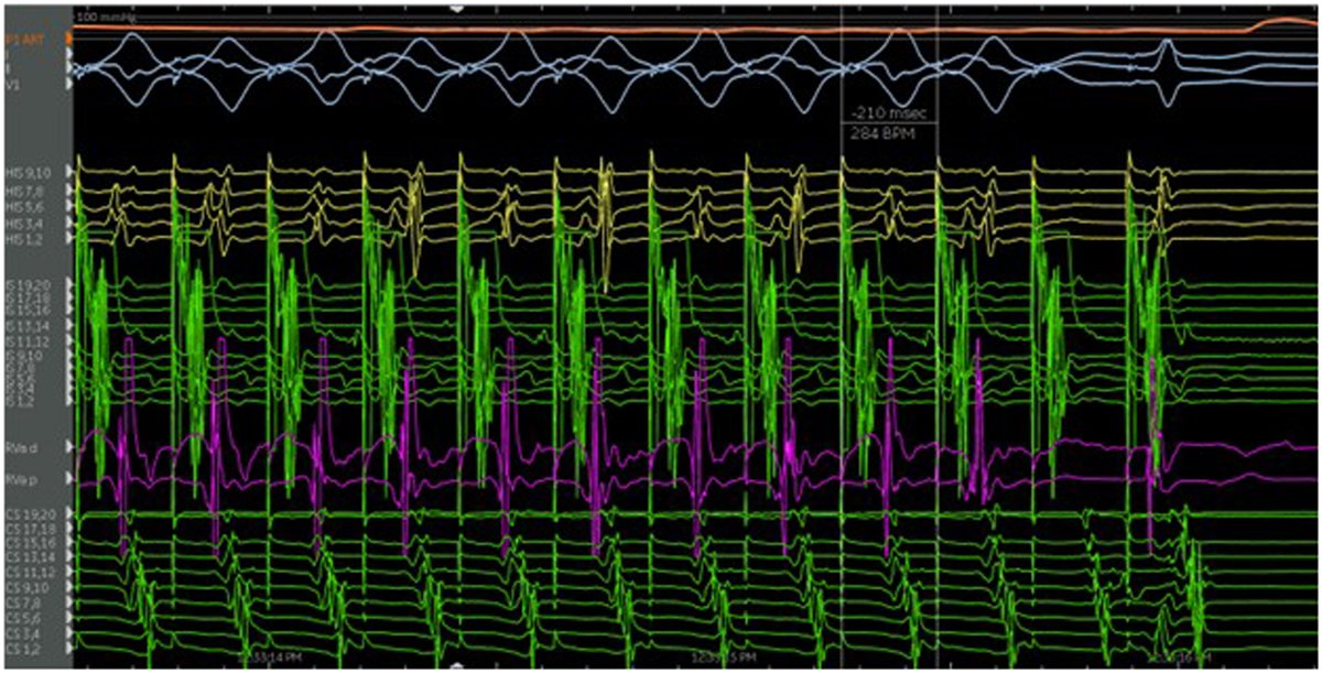 Heart Rhythm Case Reports (@hrs_casereports) on Twitter photo Non-Invasive Risk Stratification Falsely Reassuring? A Catecholamine Sensitive Accessory Pathway
<a href="/DrDeese99/">Christopher DeSimone, MD, PhD</a> <a href="/RC_Ward/">Robert Ward</a>
heartrhythmcasereports.com/article/S2214-… Non-Invasive Risk Stratification Falsely Reassuring? A Catecholamine Sensitive Accessory Pathway
<a href="/DrDeese99/">Christopher DeSimone, MD, PhD</a> <a href="/RC_Ward/">Robert Ward</a>
heartrhythmcasereports.com/article/S2214-…