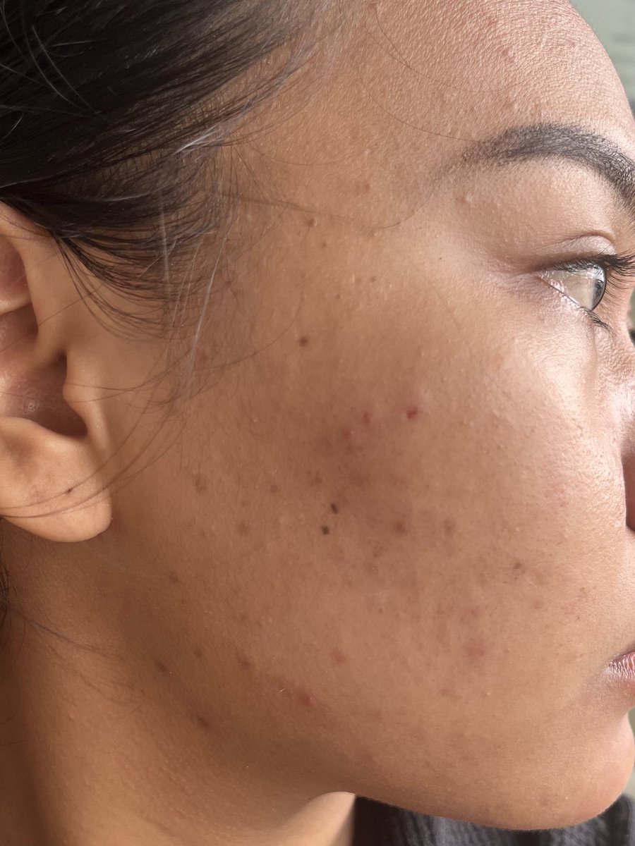 anjarivln's tweet photo. setelah lama dia upload review dan per skincarean, finally aku mau comeback 🥹 banyak bgt hal yg bikin aku off nge review, salah satunya ini aku sempet breakout parah, yang sampe merah merah dan gatel https://t.co/zktseRSgcf