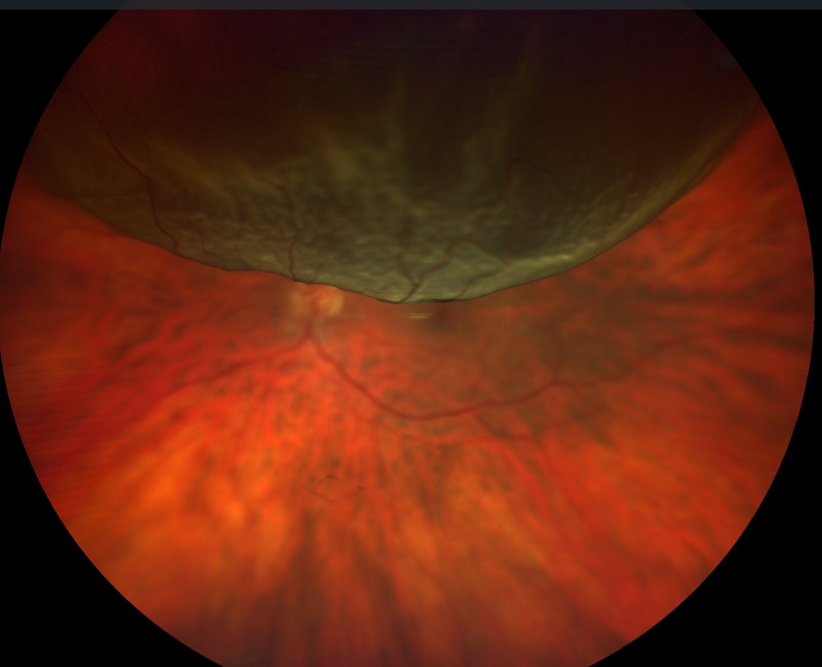 Macula on phakic rhegmatogenous retinal detachment.
