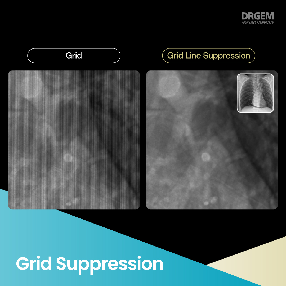 drgemhealthcare's tweet photo. DRGEM delivers sharp, accurate imaging with advanced processing for confident decisions.

✨ 9 Image Presets • 🖇️ Software Grid
🔲 Grid Suppression • 🦴 Bone Suppression

Clarity &amp; efficiency for reliable outcomes.
💡 https://t.co/Ix3L68p7FR

#YesDRGEM #ImagingQuality #RADMAX https://t.co/E0jqaUMyZw