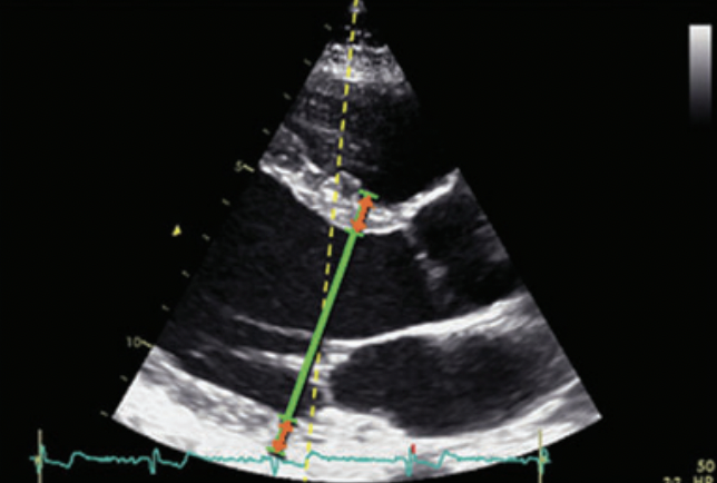 RitikaTuliMD's tweet photo. 🔹 #CardioNugget: 

LV Mass by Echo
👉 LV mass (g) =
 0.8 × 1.04 × [(IVS + LVID + PWT)³ – (LVID)³] + 0.6

IVS = interventricular septal thickness (mm)
LVID = LV internal diameter in diastole (mm)
PWT = posterior wall thickness (mm)

🧠 Key takeaways:
1.04 = myocardial density (g/cm³).
0.8 = correction factor for LV shape assumptions.

LV mass index (g/m²):
Men >115 → LVH
Women >95 → LVH

Prognostic: LV mass predicts CV events better than wall thickness alone.

🚫 When NOT to use cube formula:
-LV is asymmetric or remodeled (e.g., regional wall motion abnormalities, infarction, eccentric LVH).
-LV is not a true ellipsoid (e.g., dilated cardiomyopathy, distorted geometry).
-Poor acoustic windows → inaccurate dimension measurements.
👉 In such cases, 2D or 3D echo or CMR is preferred.

#ECHOboards #CardioTwitter #MedEd #CardioNuggets #CardiologyFellowship #FOAMed #echofirst