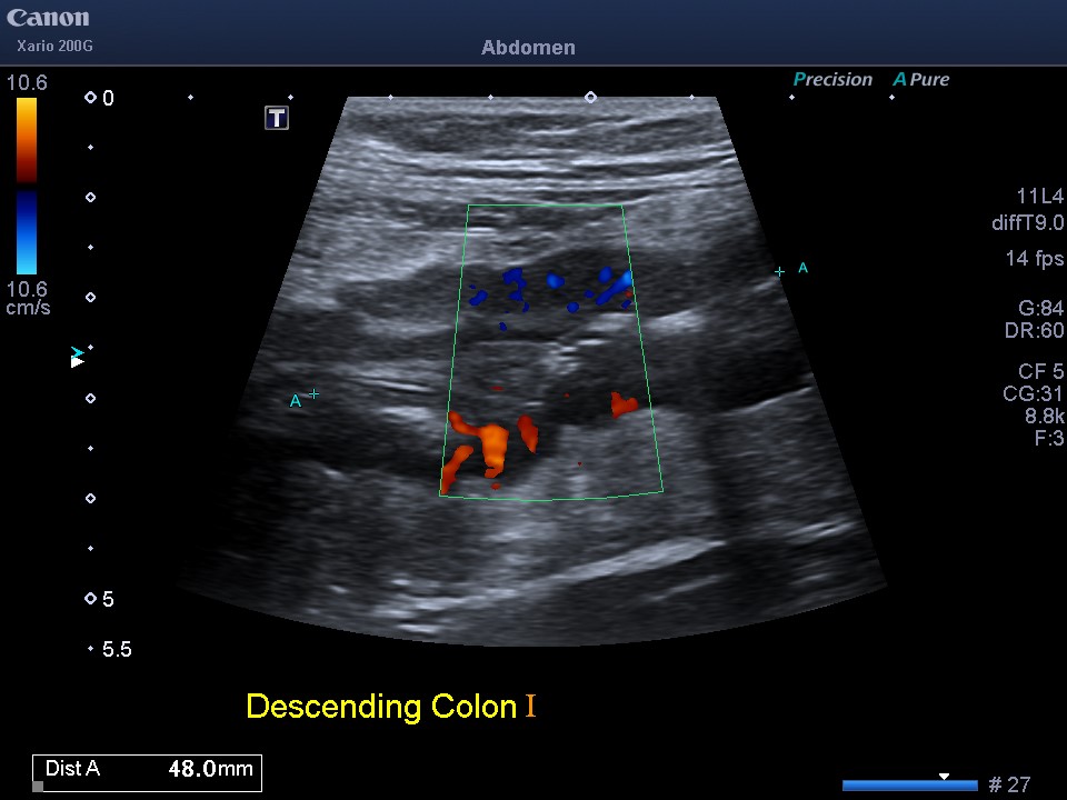 36F w stricturing colonic and perianal Crohns presents 13/40 gestation with abdominal pain and constipation; had self-ceased ustekinumab - improved with IV steroids and restarting ustekinumab, normal foetal scan. What did the IUS show?