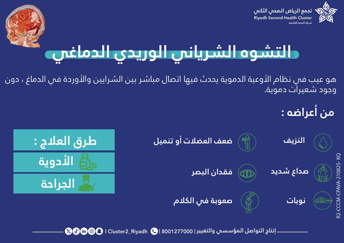 ما هو التشوه الشرياني الوريدي الدماغي؟

#مدينة_الملك_فهد_الطبية
#تجمع_الرياض_الصحي_الثاني