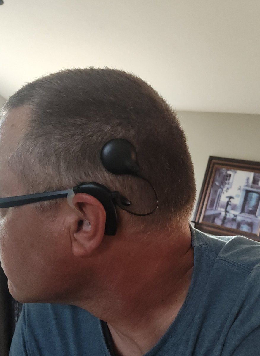 Well I can hear again...sort of. After being stone deaf for the last five years in this ear it's weird to hear things and need my brain to relearn what it's hearing.