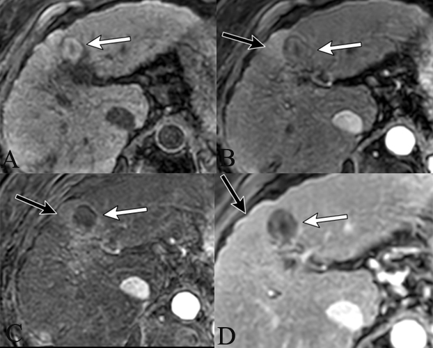 HepatomaRes's tweet photo. 🖼️ Imaging After #Liver-Directed Therapy 

🧩 Refined LI-RADS criteria for post-treatment #imaging
🧩 Improved accuracy in detecting #viable tumors
🧩 Practical insights for #multidisciplinary care

🔗 [https://t.co/J4Bj9aaYAd]
#HCC #LIRADS #LiverCancer #Imaging #Radiology https://t.co/BwAX4XhmmE