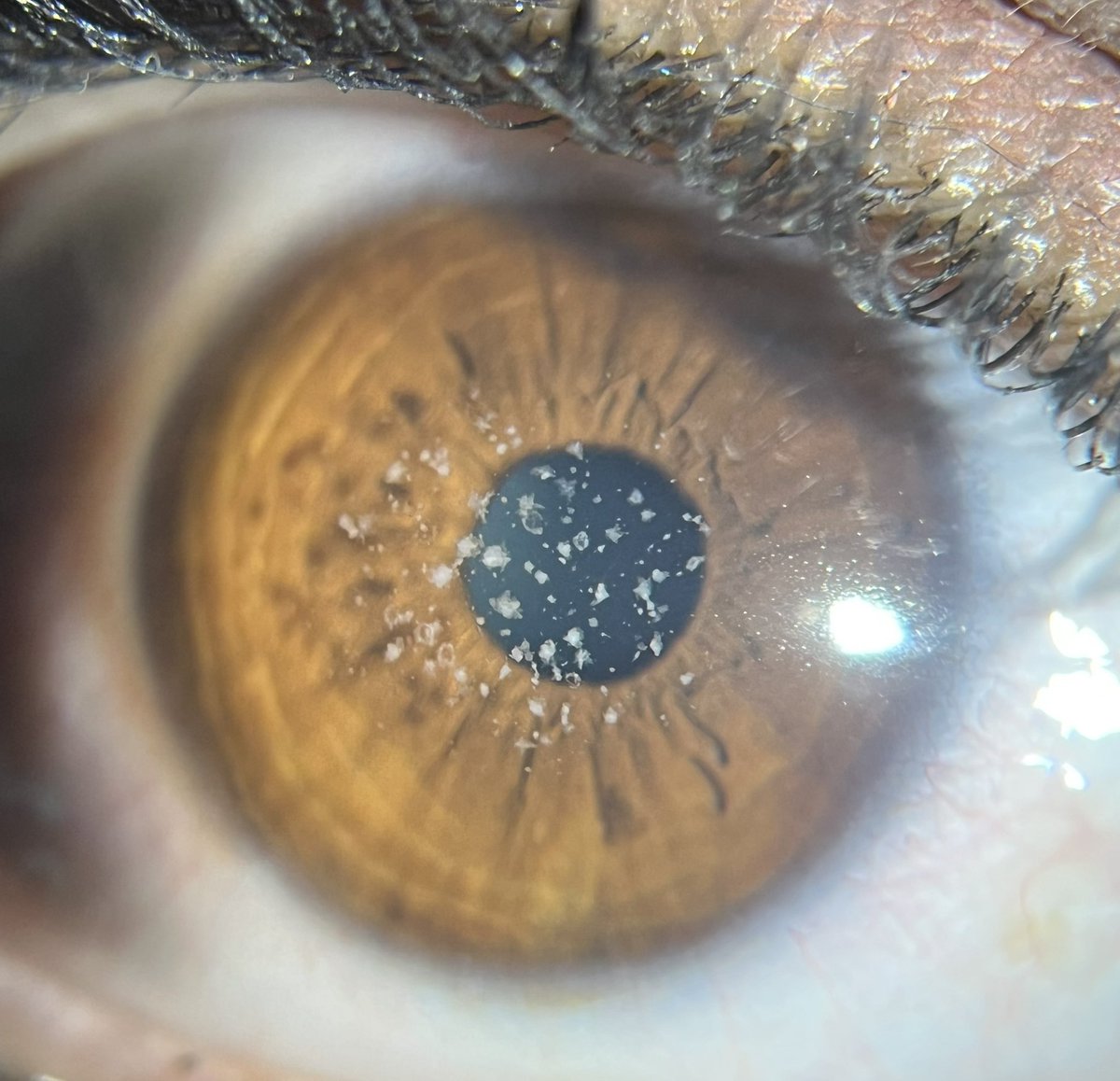 Diagnosis and Management #OphthoTwitter ??? 

#Ophthalmology #MedEd #MedTwitter
