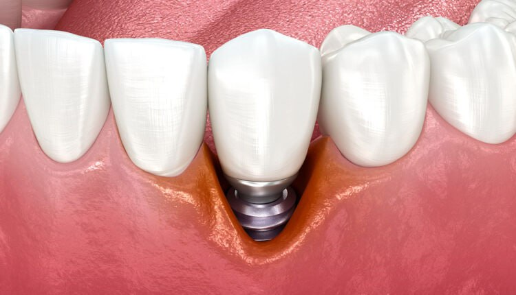 otexeworld's tweet photo. 🔩 Peri-implantitis shows unique biomarkers, distinct from periodontitis. RNA-seq identified ACTA2, FAP, PDGFRβ genes and activated fibroblasts as key drivers. This paves the way for precise diagnosis and targeted therapy, lowering relapse risk and improving implant longevity. https://t.co/KzHbnAseN3
