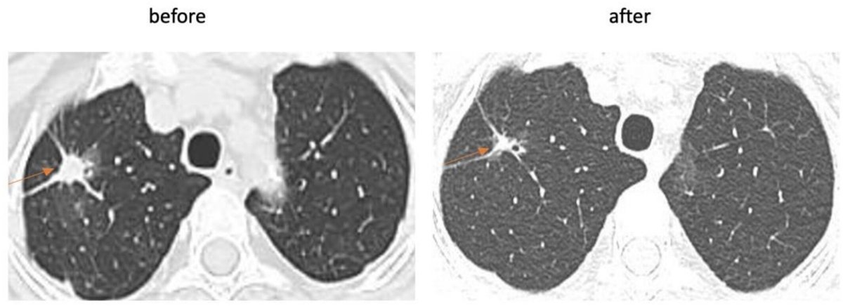 Wiley_CancerRep's tweet image. Quach et al. present a case study of patient with synchronous bilateral primary non-small cell lung cancer (#NSCLC) with different mutations in #EGFR—G719C in exon 18 in right lung &amp;amp; exon 19 deletion in left lung.
doi.org/10.1002/cnr2.7…
#CancerReports #CaseReport
@WileyOnc_Hem