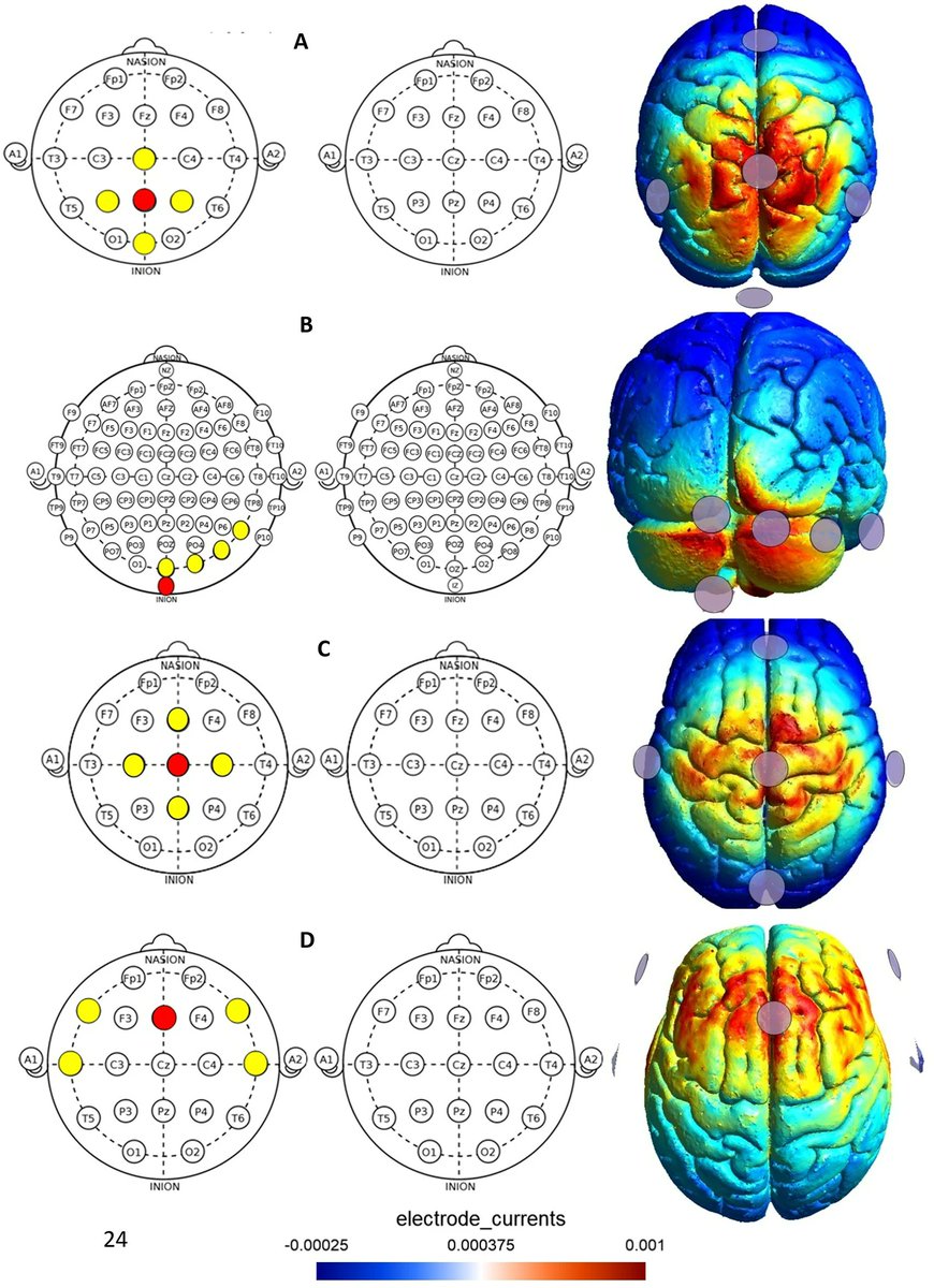 Neuroelectrics's tweet image. 🧍 Can brain-targeted tDCS improve posture adaptation?
Using our Starstim (
neuroelectrics.com/products/resea…), researchers found PPC &amp;amp; cerebellar stimulation significantly enhanced postural control vs. M1/ACC/sham.
👏 Well done to the team!
#tDCS #Balance #Posture #Neurorehab