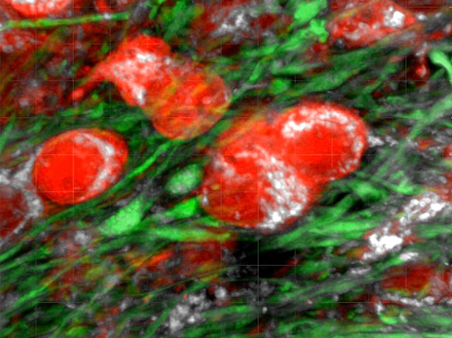 Damage to axons in white matter by early glioblastoma (GBM) cells drives progression &amp; spread of this aggressive, incurable brain tumour
#GBM 

📹 Melanie Clements, Wenhao Tang, Zan Florjanic Baronik, Holly Simpson Ragdale et al <a href="/uclcancer/">UCL Cancer Institute</a> in <a href="/Nature/">nature</a> 
➡️ bpod.org.uk/archive/2025/8…