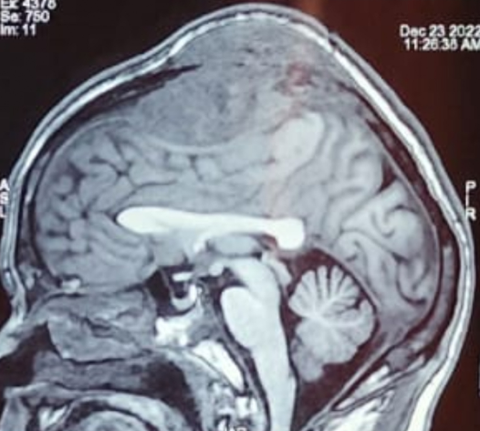 👨‍🎨A 44-year-old man presented with a progressive scalp mass, visual disturbances, and weakness of one leg.

🧑‍⚕️What differential diagnoses would you consider?