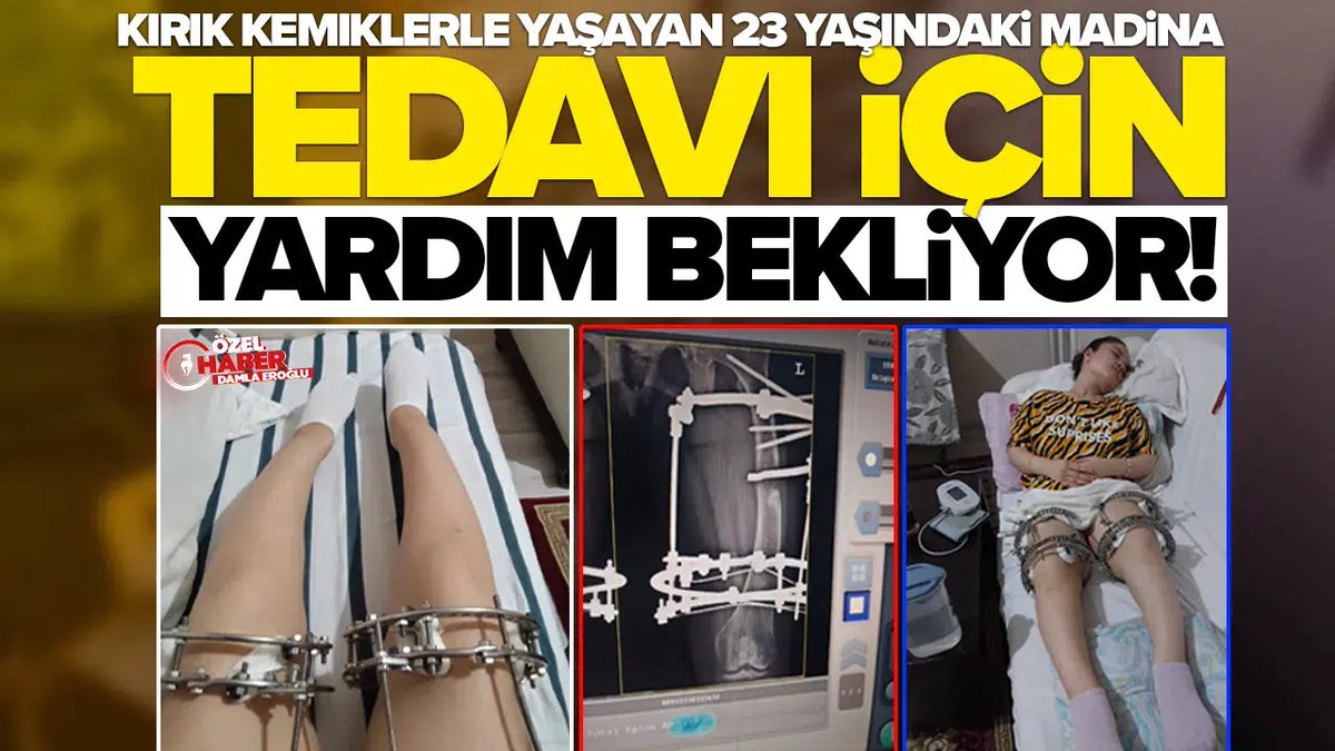 Kırık kemiklerle yaşayan 23 yaşındaki Madina, tedavi için yardım bekliyor!

Özel Haber - Damla Eroğlu

iscihaber.net/ozel-haber/kir…
<a href="/MArslankizi/">kızım icin destek istiyorum</a> <a href="/av_burcuaslan/">Av.Burcu ASLAN</a> <a href="/saglikbakanligi/">T.C. Sağlık Bakanlığı</a> <a href="/sedat_peker/">Sedat Peker</a>