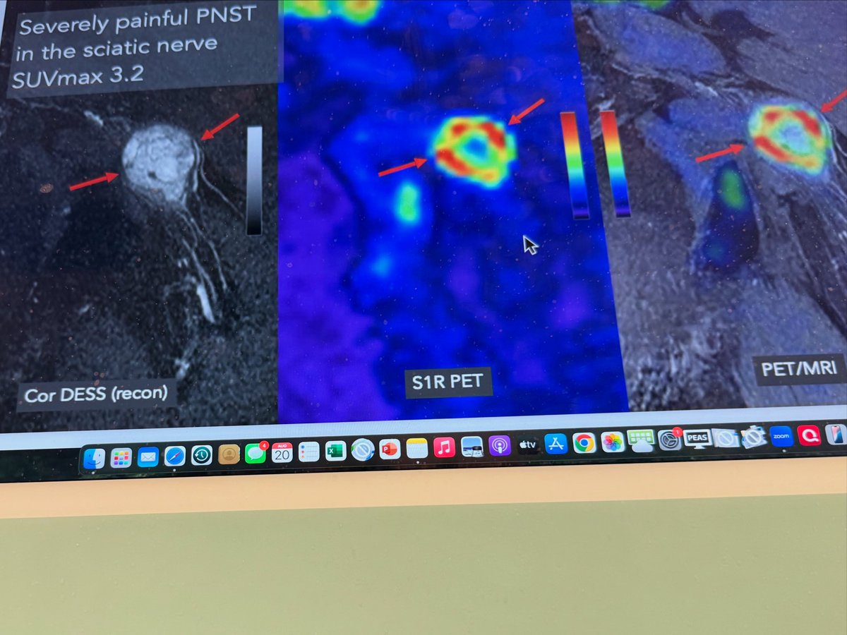 krishmdphd's tweet image. The new biomarker for pain???  Excited to be a FOUNDING ADVISOR for PainVox.  Incredible data showing that radiotracers will change the pain management space unlike anything I have seen.  The future for our speciality is 🔥. VAMOS! 
#pain #paindiagnosis #radiotracer #petctscan