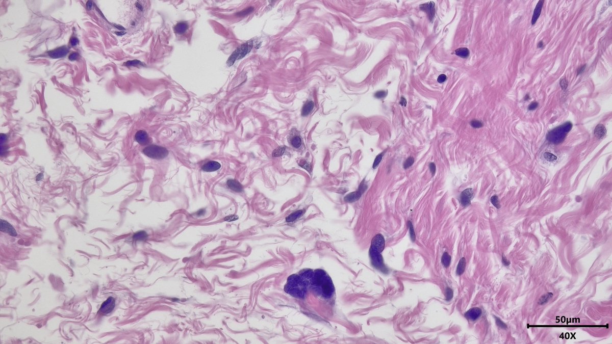 Thoughts on these big cells? Found in the stroma of a mastectomy for extensive DCIS #breastpath #pathx #pathtwitter #pathresidents