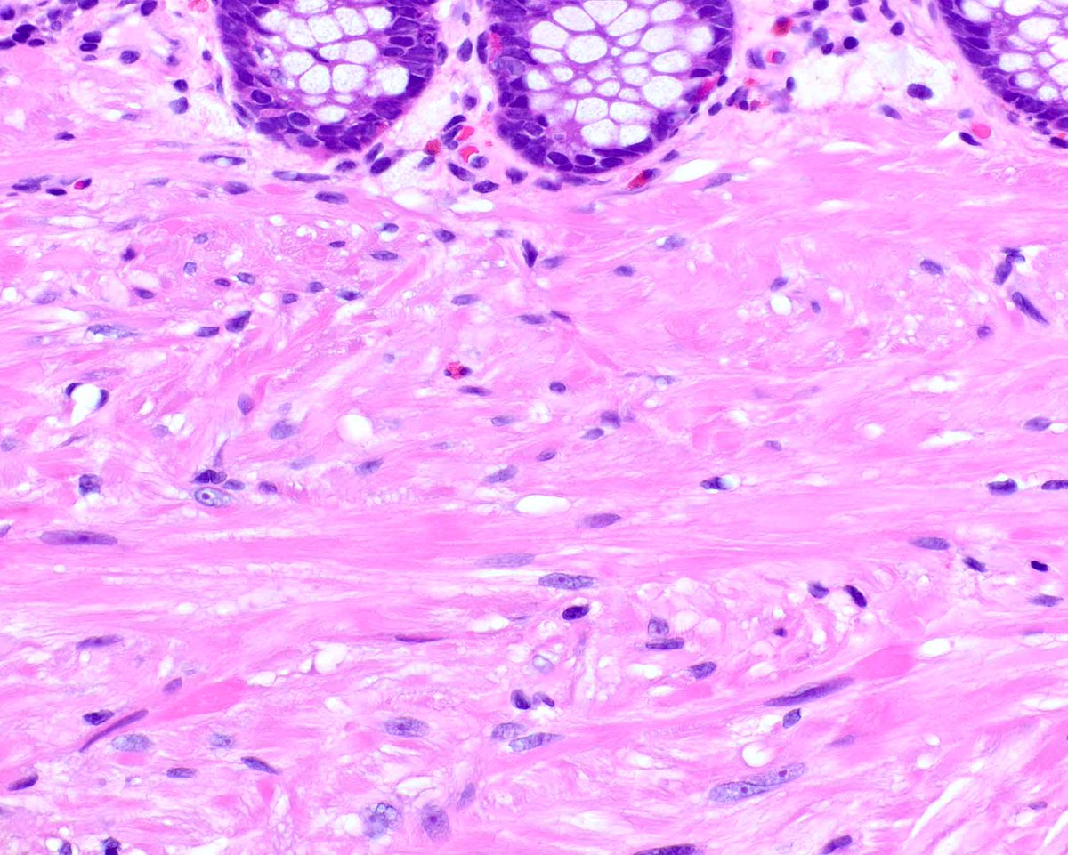 Modern Pathology (@modernpathology) on Twitter photo Another Modern Pathology classic - Miettinen M, Sarlomo-Rikala M, Sobin LH. Mesenchymal tumors of muscularis mucosae of colon and rectum are benign leiomyomas that should be separated from gastrointestinal stromal tumors--a clinicopathologic and immunohistochemical study of Another Modern Pathology classic - Miettinen M, Sarlomo-Rikala M, Sobin LH. Mesenchymal tumors of muscularis mucosae of colon and rectum are benign leiomyomas that should be separated from gastrointestinal stromal tumors--a clinicopathologic and immunohistochemical study of