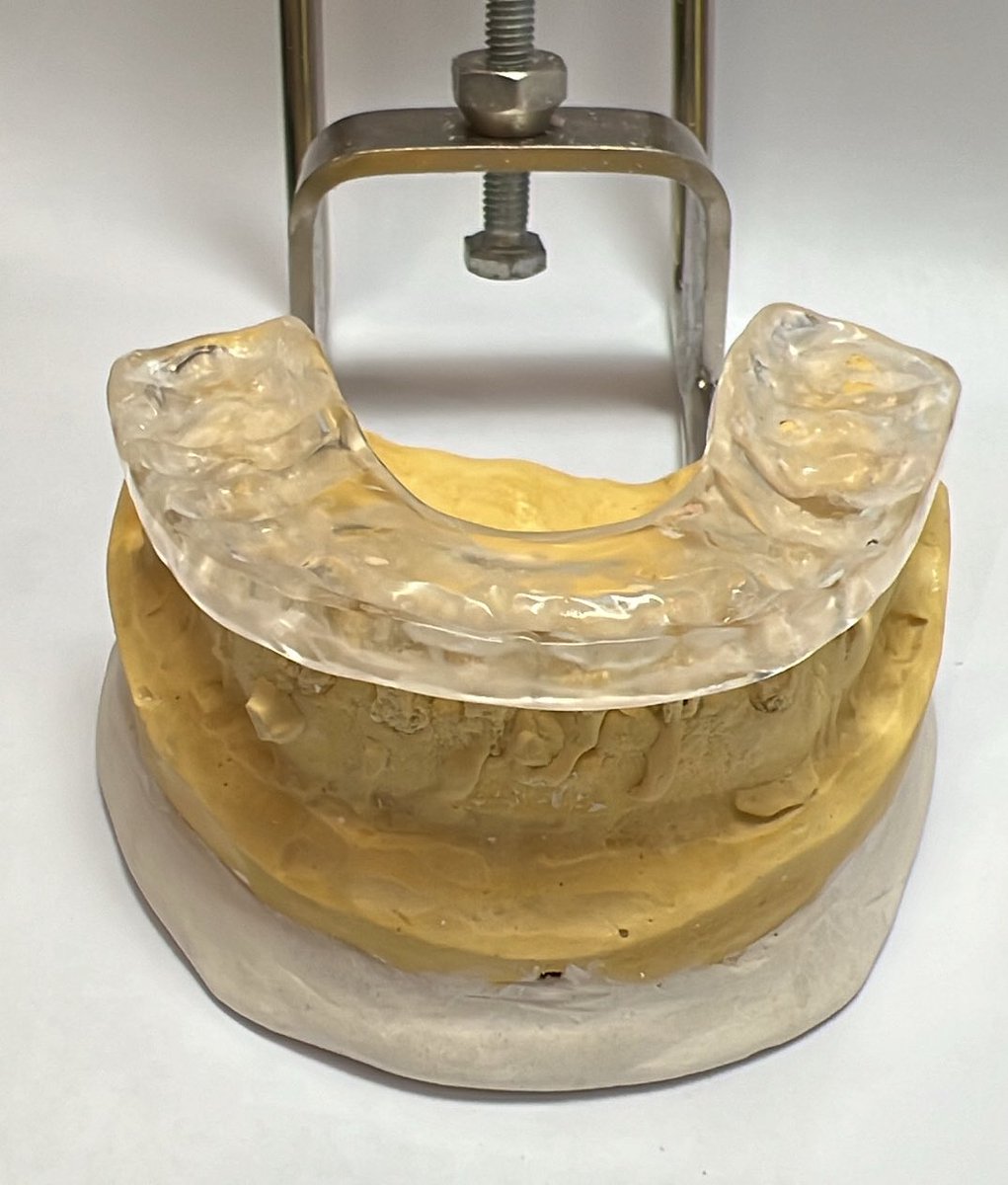 A surgical guide in orthognathic surgery ensures that the jaws are positioned exactly as planned during the operation.

Real cases &amp; lessons 👍🏻