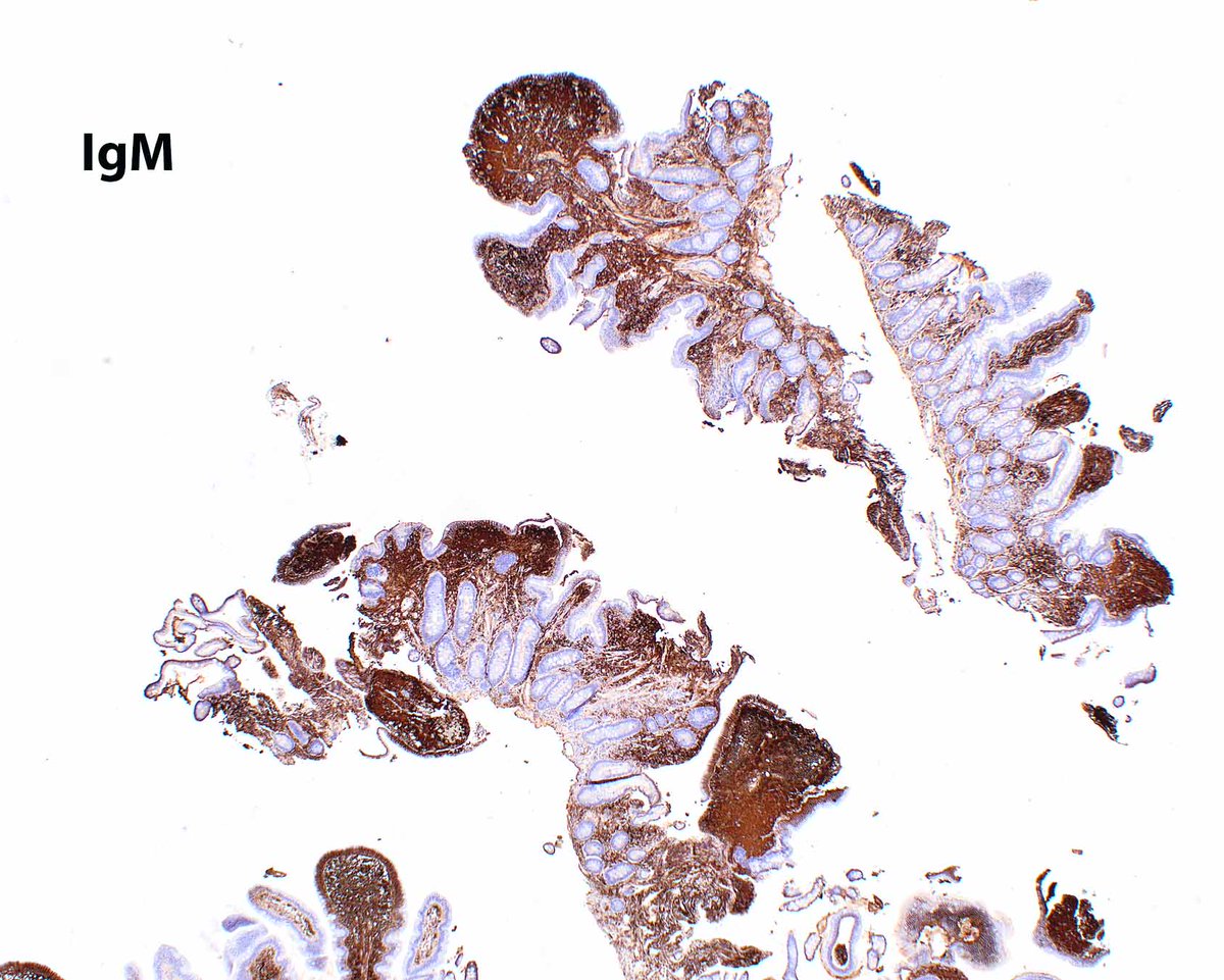 These small intestinal biopsies from a patient with markedly elevated serum IgM from a splenic plasmacytoid extranodal marginal zone (mucosa-associated lymphoid tissue) lymphoma show dramatic edema and IgM deposition that resulted in malabsorption. There is no lymphoma.