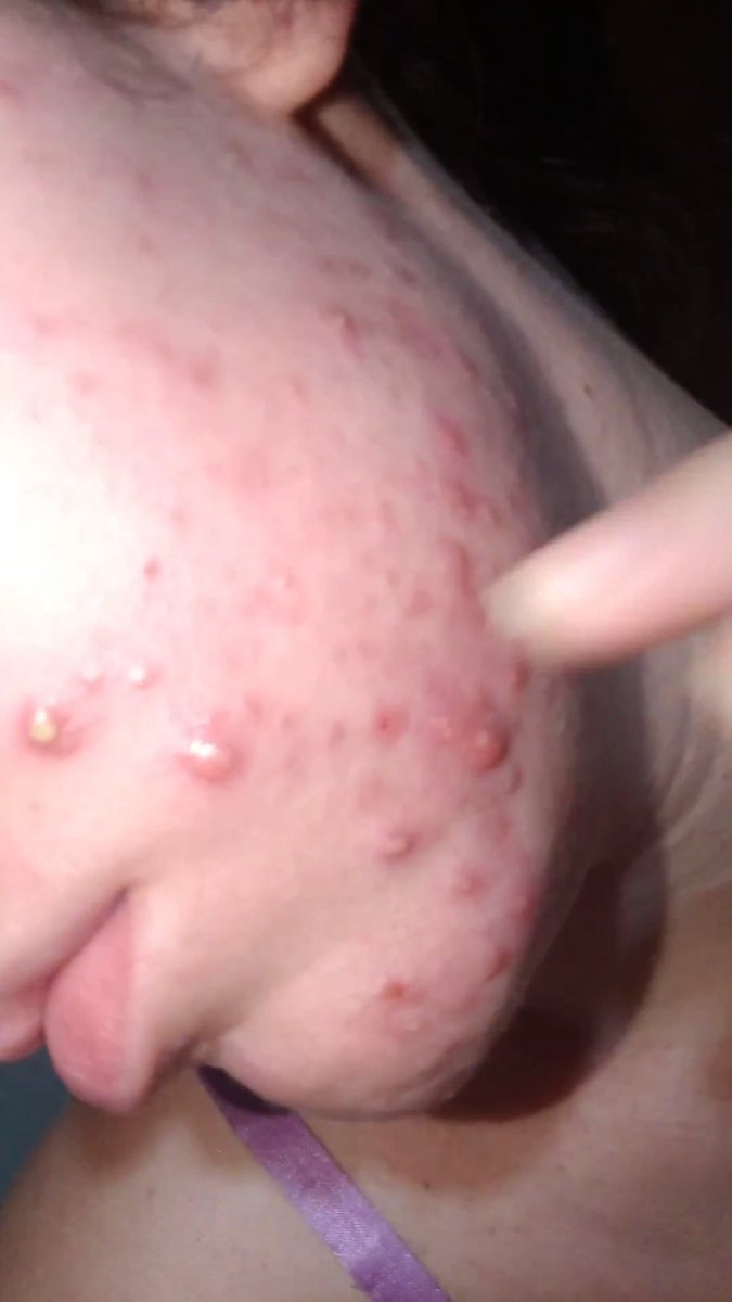eloizamarcelle's tweet photo. @RaonyPhillips O basicão que todo mundo tem... Ressecamento de todas as mucosas, fazendo com que nariz e lábios descamassem muitoooo, olhos ressecados TB, exames bioquímicos mensais, e o melhor resultado que minha pele poderia ter 
Eu saí disso pra isso sabe https://t.co/zzlfxzIfPQ