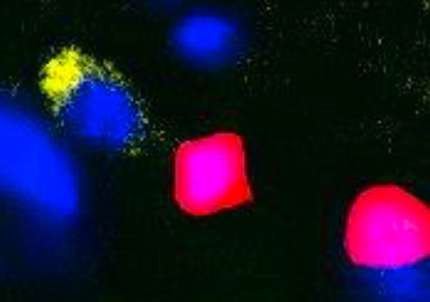 🔬 Sclérose en plaques : quand les régulateurs du système immunitaire jouent les incendiaires

L’Inserm vient de publier une étude intéressante sur la sclérose en plaques (SEP). Elle révèle que certaines cellules du système immunitaire, censées calmer l’inflammation, joueraient
