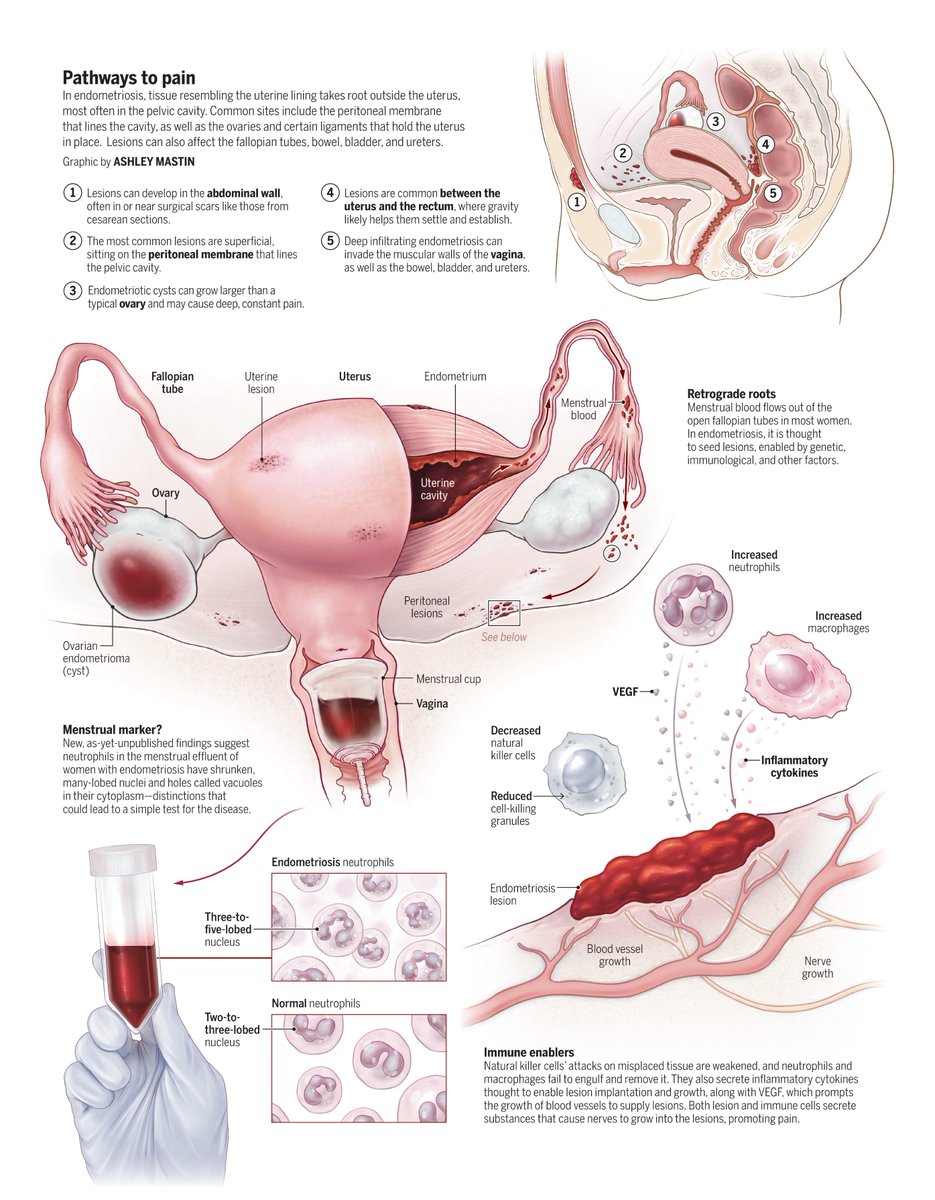 ScienceMagazine's tweet image. A scientist is helping uncover the role of the immune system in endometriosis—while managing the disease herself.

Learn more: scim.ag/3ViJIUV @NewsfromScience