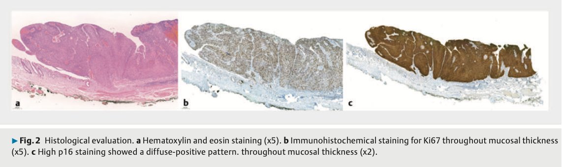 First experience worldwide of ESD for the treatment of anal Squamous Cell Carcinoma. Thanks to all authors to contribute to expand indications and frontiers of ESD! #GITwitter #MedEd #Endoscopy #Endoscopia <a href="/DigValdecilla/">DigestivoValdecilla</a> <a href="/HUnivValdecilla/">Hospital Universitario Marqués de Valdecilla</a> <a href="/SEEDendoscopia/">SEED</a>
<a href="/sepdigestiva/">Sociedad Española de Patología Digestiva (SEPD)</a> <a href="/ESGE_news/">ESGE</a>