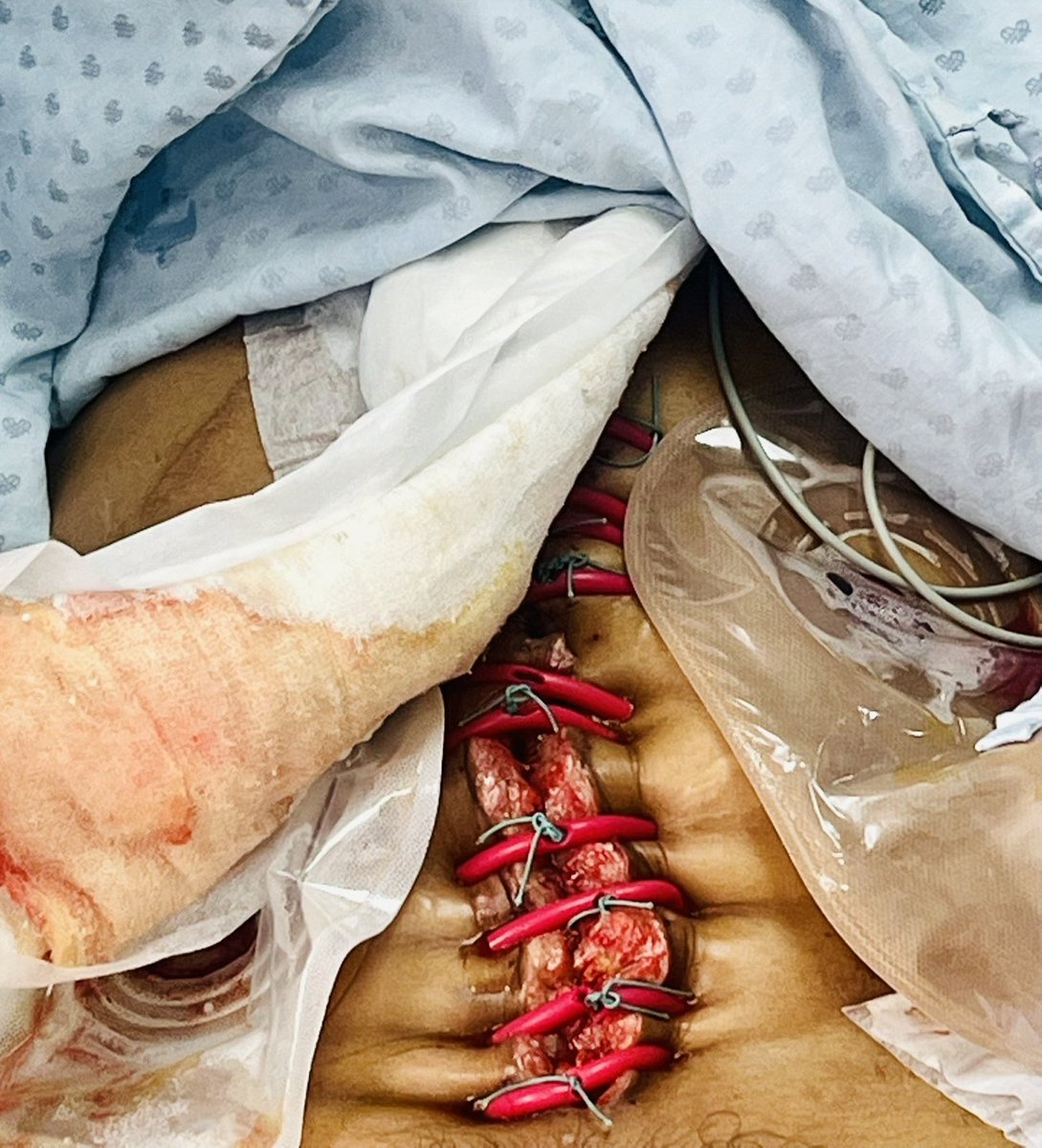 migueriv69's tweet photo. "alternativas " para el manejo de la sepsis abdominal y evisceracion

En realidad no se cuál  esta peor https://t.co/oqZXGhGbDe