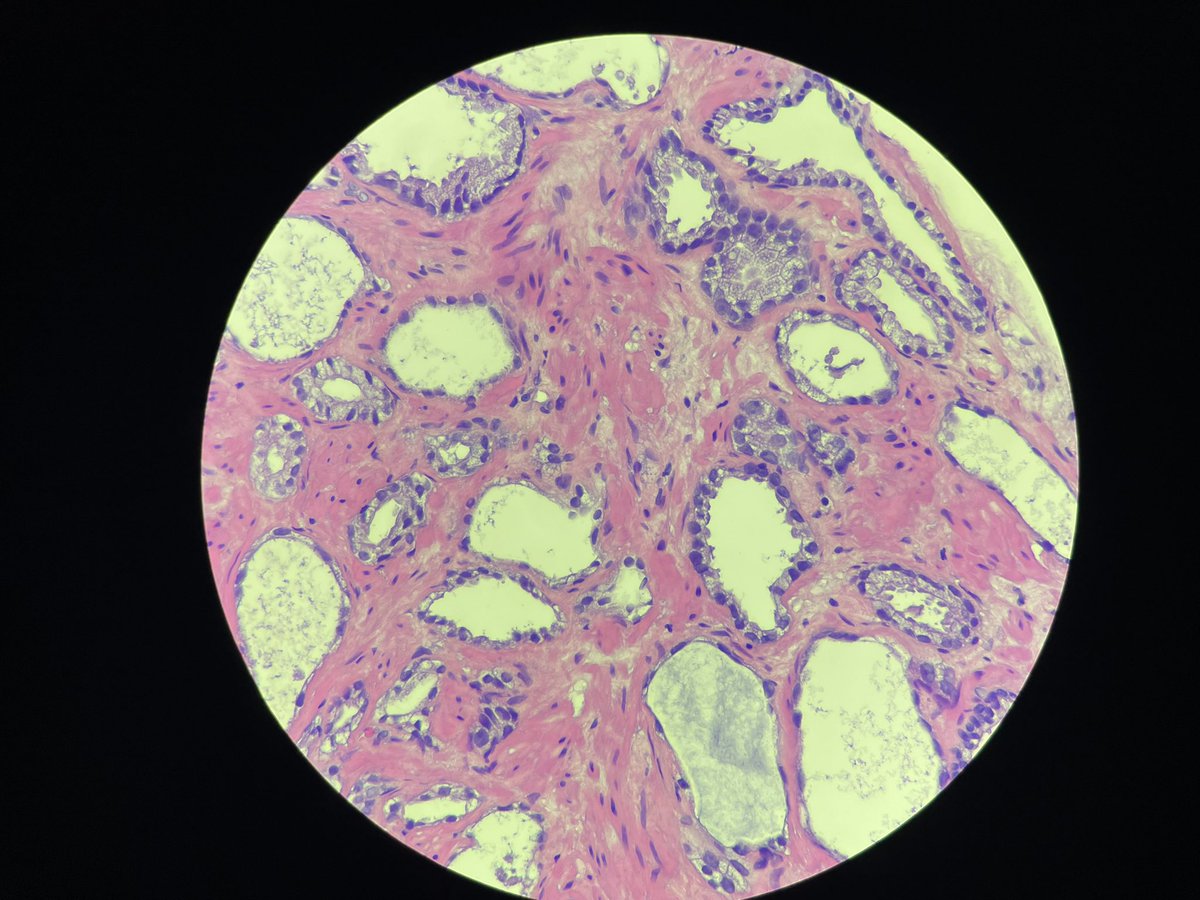 Juggling_path's tweet photo. @slusagar My very NEXT case after your post— atrophic cancer 😂. There are surrounding usual cancer glands so no problem, but out of context, a few these glands at the edge of a core… really tricky. And I think ihc may not help (thank you for all your great posts!) https://t.co/7bdETYi3FQ
