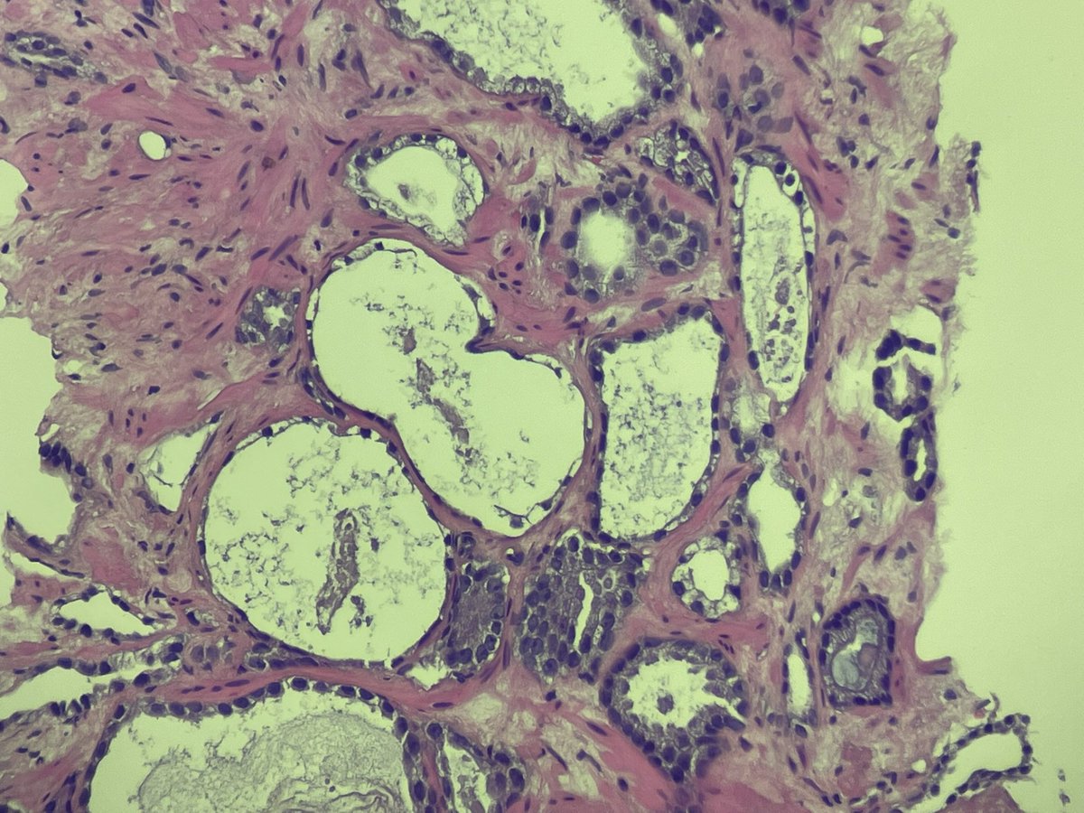 Juggling_path's tweet photo. @slusagar My very NEXT case after your post— atrophic cancer 😂. There are surrounding usual cancer glands so no problem, but out of context, a few these glands at the edge of a core… really tricky. And I think ihc may not help (thank you for all your great posts!) https://t.co/7bdETYi3FQ
