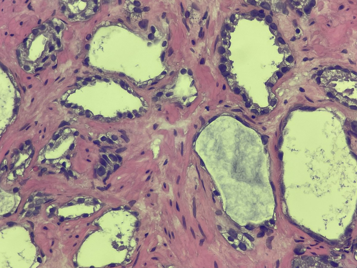 Juggling_path's tweet photo. @slusagar My very NEXT case after your post— atrophic cancer 😂. There are surrounding usual cancer glands so no problem, but out of context, a few these glands at the edge of a core… really tricky. And I think ihc may not help (thank you for all your great posts!) https://t.co/7bdETYi3FQ
