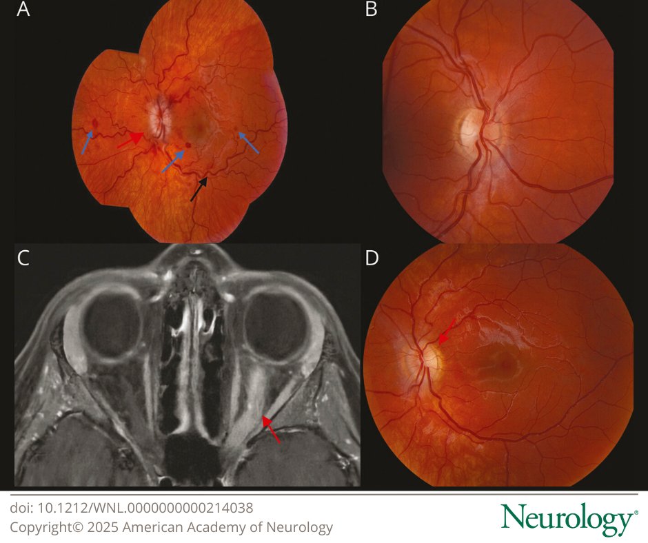 This case highlights that venous stasis retinopathy can occur in MOGAD, which is believed to be due to the profound optic disc edema and/or inflammation of the optic nerve and sheath leading to compression of the central retinal vein: hubs.la/Q03FZj8m0 
#NeuroImage #NeuroX