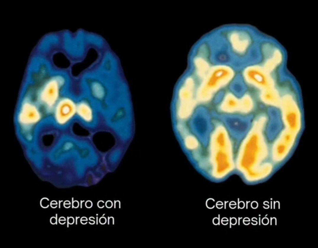 <a href="/drajohitasilva/">Johita Silva</a> Los trastornos mentales existen. El metabolismo cerebral esta alterado. Asi como la neuroquimica... por negar eso es que no buscan ayuda