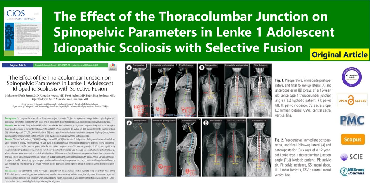 CiOSjournal's tweet image. The Effect of the Thoracolumbar Junction on Spinopelvic Parameters in Lenke 1 Adolescent Idiopathic Scoliosis with Selective Fusion
🌷doi.org/10.4055/cios24…
Clin Orthop Surg. 2025 Jun;17(3) Muhammed Fatih Serttas
#Adolescent #Scoliosis #Thoracic_vertebrae #Kyphosis