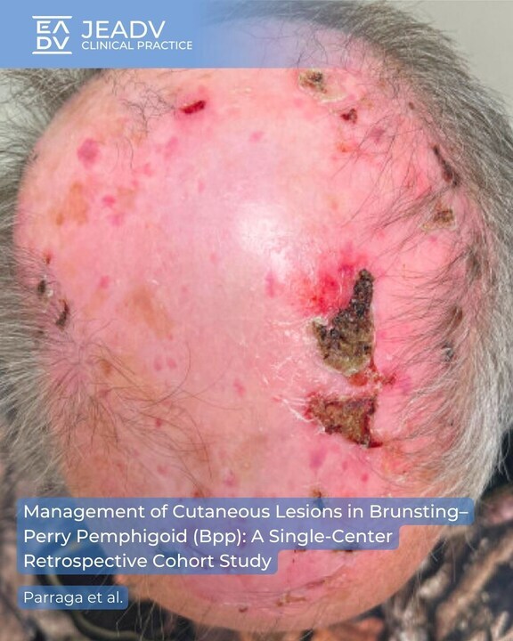 In their contribution, Parraga et al. report on 10 cases of Brunsting–Perry pemphigoid (BPP), a rare autoimmune #skincondition. Methotrexate (MTX) and mycophenolate mofetil (MMF) were well tolerated, with 90% of #patients improving.

👉 bit.ly/40c9rBo