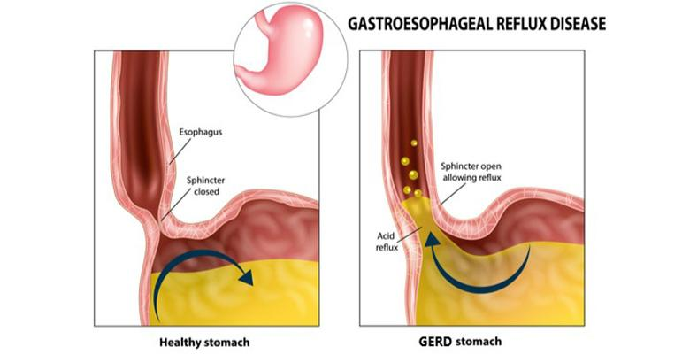 VirtudMental's tweet image. Te arde el pecho.
La comida se siente atascada.
El ácido sigue subiendo a tu garganta.
Y no importa cuánta medicina tomes…
Nunca desaparece
Se llama “reflujo ácido” y millones de estadounidenses lo padecen.
Esto es lo que es, qué lo causa y cómo deshacerse de él para…