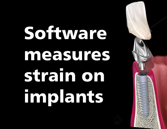 DataAcquisition's tweet image. Check out how researchers are using Windmill software to improve dental implant longevity! 🦷By precisely measuring strain on implants under different conditions, they&apos;ve identified the designs for max durability
🔗windmill.co.uk/monitor315.htm… #Dentistry #DentalImplants #DataLogging