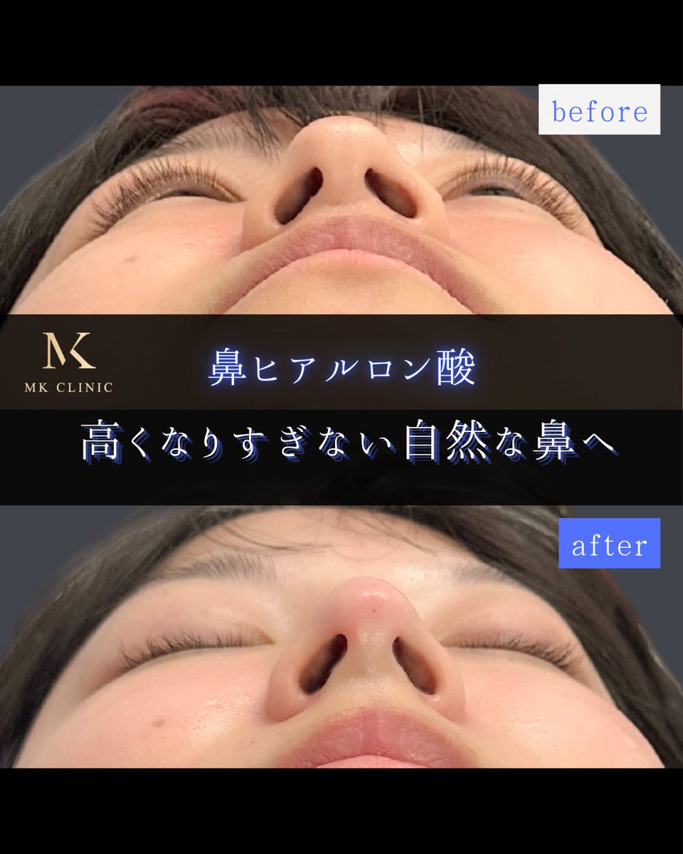 N2bc0728's tweet image. 🪼9月限定CP🪼

ニキビ肌で悩んでいる…
フェイスラインをすっきりさせたい…
そんな方におすすめの施術がございます😊✨

石田院長の施術限定メニューもご用意！

気になる施術がある方は公式LINEへ
👉lin.ee/T0X94W2