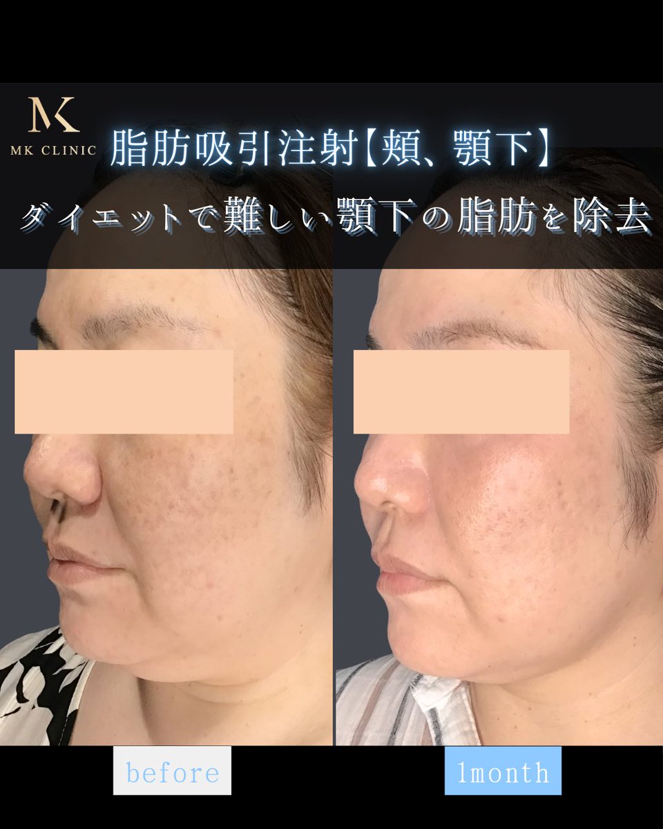 N2bc0728's tweet image. 🪼9月限定CP🪼

ニキビ肌で悩んでいる…
フェイスラインをすっきりさせたい…
そんな方におすすめの施術がございます😊✨

石田院長の施術限定メニューもご用意！

気になる施術がある方は公式LINEへ
👉lin.ee/T0X94W2