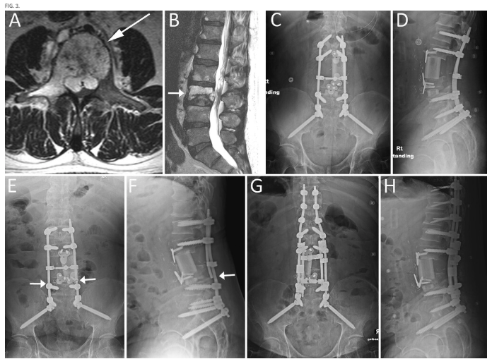 TheJNS's tweet photo. #FreeArticle. Study identifies risk factors for mechanical complications in reconstructive surgery following primary spinal column tumor spondylectomy. 

https://t.co/o1wP6qSeqL https://t.co/nJD3pEFmJq