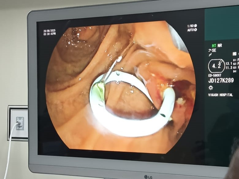 iamdmkrishna's tweet image. The successful completion of our first urgent ERCP with CBD stenting at Krishna Vikash Hospital, Bhalupali, Sambalpur marks a significant step forward in patient care.

@dpradhanbjp 

#krishnavikash #krishnavikashhospitals #sambalpur