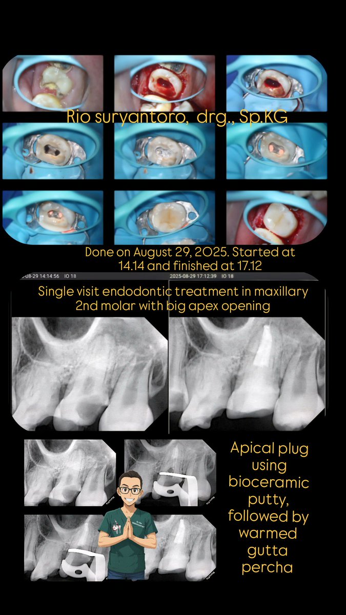 Single visit endodontic treatment in maxillary 2nd molar with big apical opening. Done on August 29, 2025. Started at 14.14 and finished at 17.12.

Apical plug using bioceramic putty, followed by warmed gutta percha.

#doktergigi #endodontist #spesialiskonservasigigi